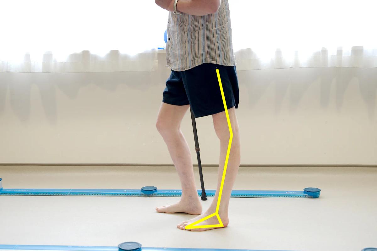 Gait Analysis